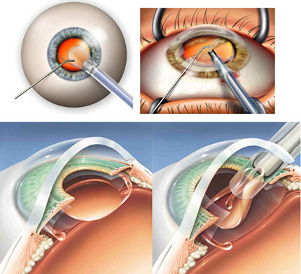 Micro-incision Cataract Surgery