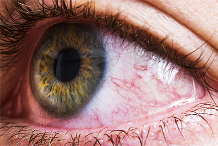 Treatment Of Painful Or Red Eyes